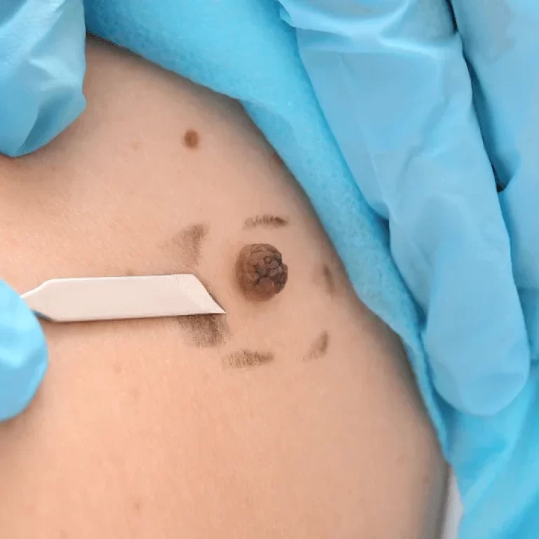 Skin-tag-removal-1